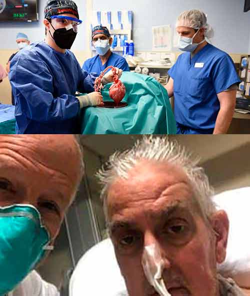 В США пациент, которому впервые пересадили сердце свиньи, умер через два месяца после операции.